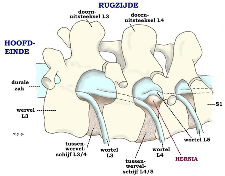 Hernia van de tussenwervelschijf