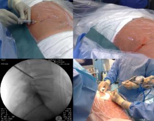 PTED endoscopische hernia techniek