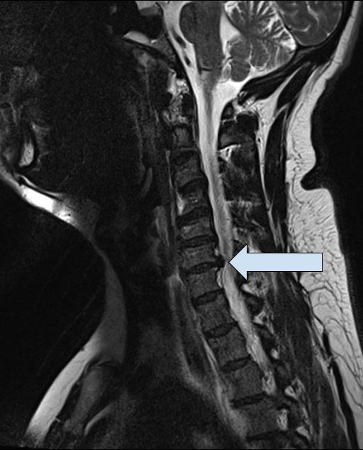 nekhernia